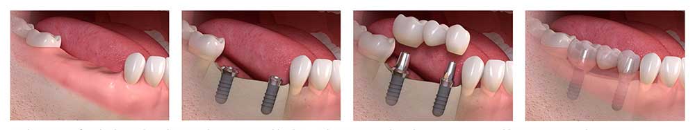 Bridge Implants by Mallette Dental, Canton Ohio