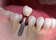 a single tooth implant - Dr. Jeff Mallette Canton Ohio