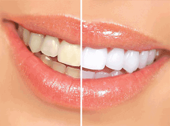 teeth whitening before and after