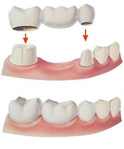 Installation of a dental bridge: Canton Ohio's Mallette Dental