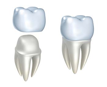 Dental Crown: Mallette Dental Canton Ohio