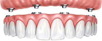 Implant Dentures from Mallettte Dental